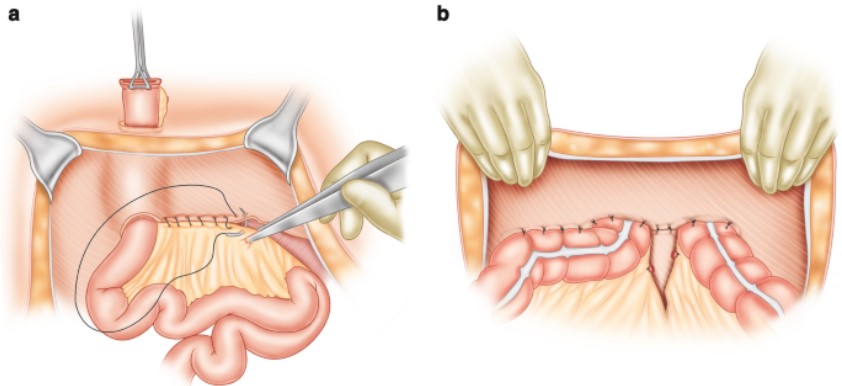 Stoma Management and Dermal Well-Being: Preventing and Addressing Frequent Concerns